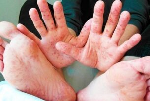 Новини Києва - У Києві фіксують спалах кору та гепатиту А